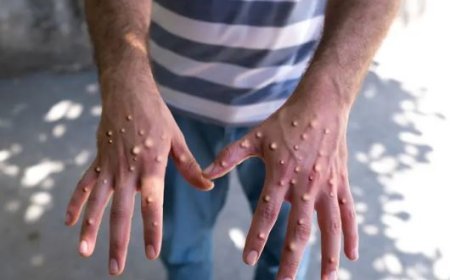 Mpox अपडेट: सफदरजंग अस्पताल को बनाया गया मंकीपॉक्स सेंटर, AIIMS में भी पांच बेड आरक्षित