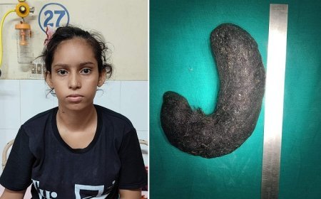 शाहजहांपुर न्यूज़: किशोरी के पेट में निकला बालों का गुच्छा, मेडिकल कॉलेज के डाक्टरों ने किया सफल आपरेशन। 