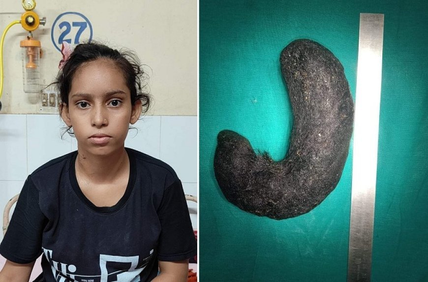 शाहजहांपुर न्यूज़: किशोरी के पेट में निकला बालों का गुच्छा, मेडिकल कॉलेज के डाक्टरों ने किया सफल आपरेशन। 