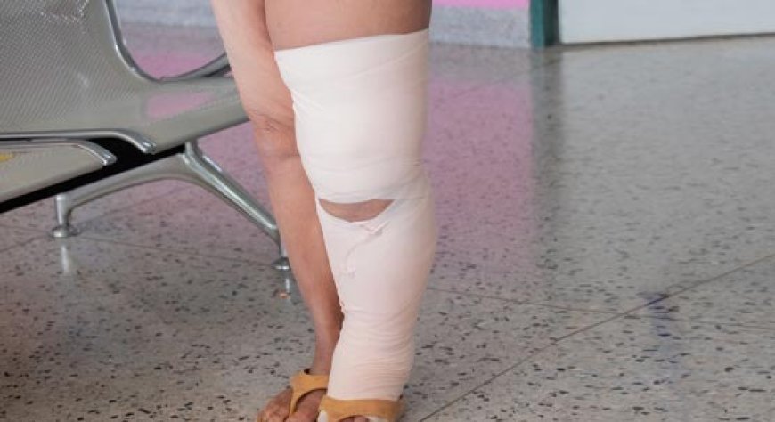 Lucknow : योगी सरकार का लक्ष्य 2027 तक फाइलेरिया मुक्त हो उत्तर प्रदेश, फाइलेरिया उन्मूलन अभियान शुरू