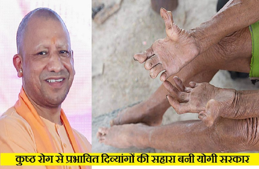 Yogi govt emerges as a lifeline for leprosy-affected persons with disabilities