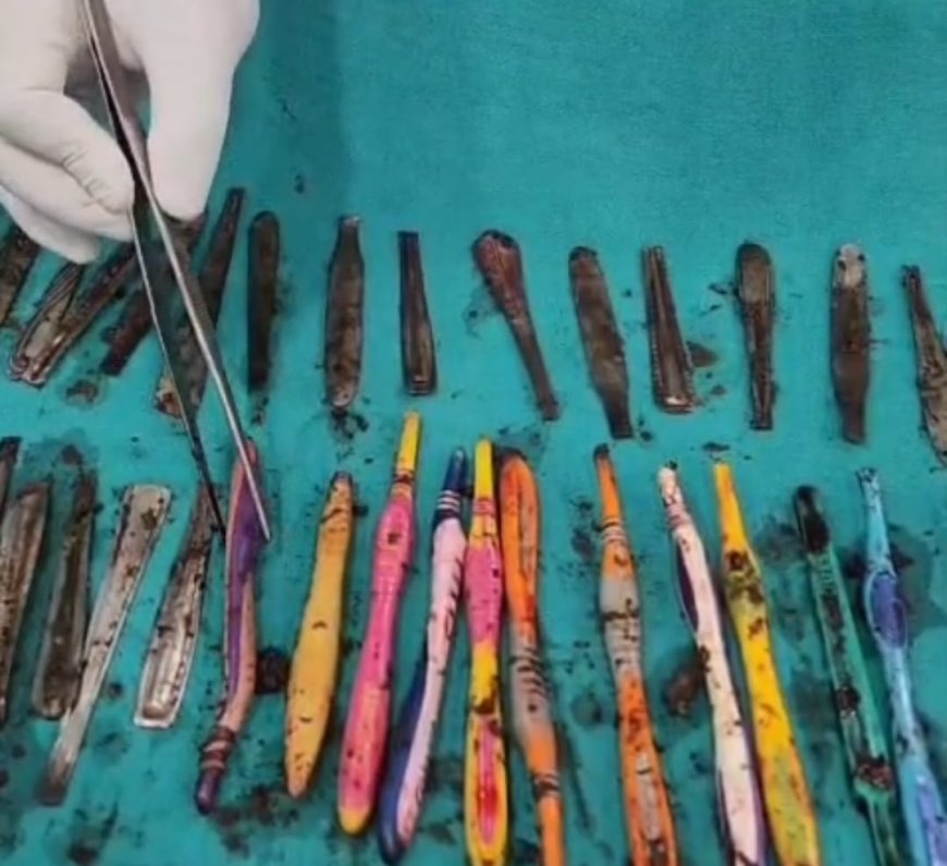 Hapur : हापुड़ में चौंकाने वाला मामला- मरीज के पेट से निकले 29 स्टील के चम्मच, 19 टूथब्रश और दो पेन