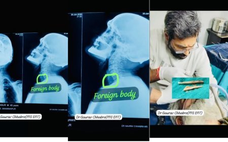 Saharanpur : सहारनपुर में डॉक्टर गौरव छाबड़ा ने जटिल ऑपरेशन कर 55 वर्षीय मरीज की जान बचाई