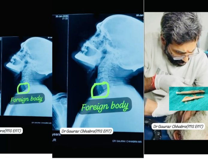 Saharanpur : सहारनपुर में डॉक्टर गौरव छाबड़ा ने जटिल ऑपरेशन कर 55 वर्षीय मरीज की जान बचाई