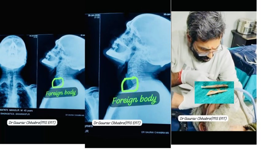 Saharanpur : सहारनपुर में डॉक्टर गौरव छाबड़ा ने जटिल ऑपरेशन कर 55 वर्षीय मरीज की जान बचाई