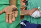 पंढरपुर में चिकित्सा लापरवाही का बड़ा मामला: डॉक्टर ने बच्चे के दाहिने हाथ के बजाय कर दी बाएं हाथ की सर्जरी।