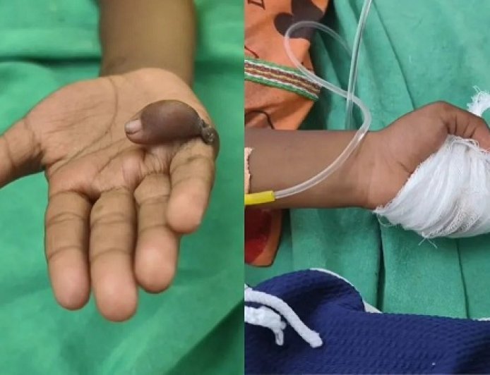 पंढरपुर में चिकित्सा लापरवाही का बड़ा मामला: डॉक्टर ने बच्चे के दाहिने हाथ के बजाय कर दी बाएं हाथ की सर्जरी।