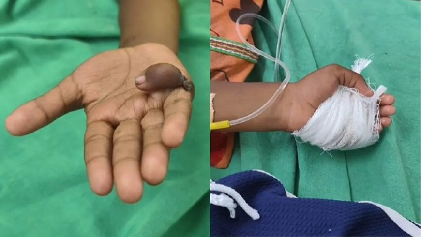 पंढरपुर में चिकित्सा लापरवाही का बड़ा मामला: डॉक्टर ने बच्चे के दाहिने हाथ के बजाय कर दी बाएं हाथ की सर्जरी।