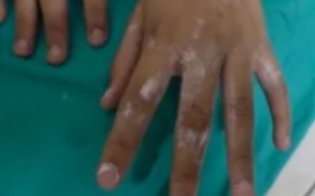 Gonda News: गोंडा में मिड-डे मील के दौरान रसोइया ने छात्रा पर डाली गर्म सब्जी, हाथ की चार उंगलियां झुलसीं