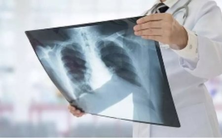 Delhi TB Cases Surge: दिल्ली में टीबी के मामलों में तेज उछाल, 42 दिनों में 12,078 नए मरीज मिले; जानिए प्रमुख लक्षण