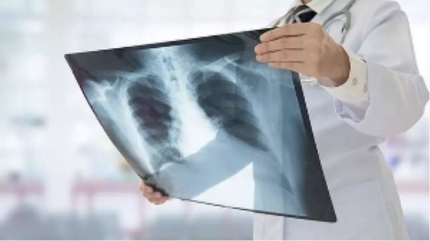 Delhi TB Cases Surge: दिल्ली में टीबी के मामलों में तेज उछाल, 42 दिनों में 12,078 नए मरीज मिले; जानिए प्रमुख लक्षण